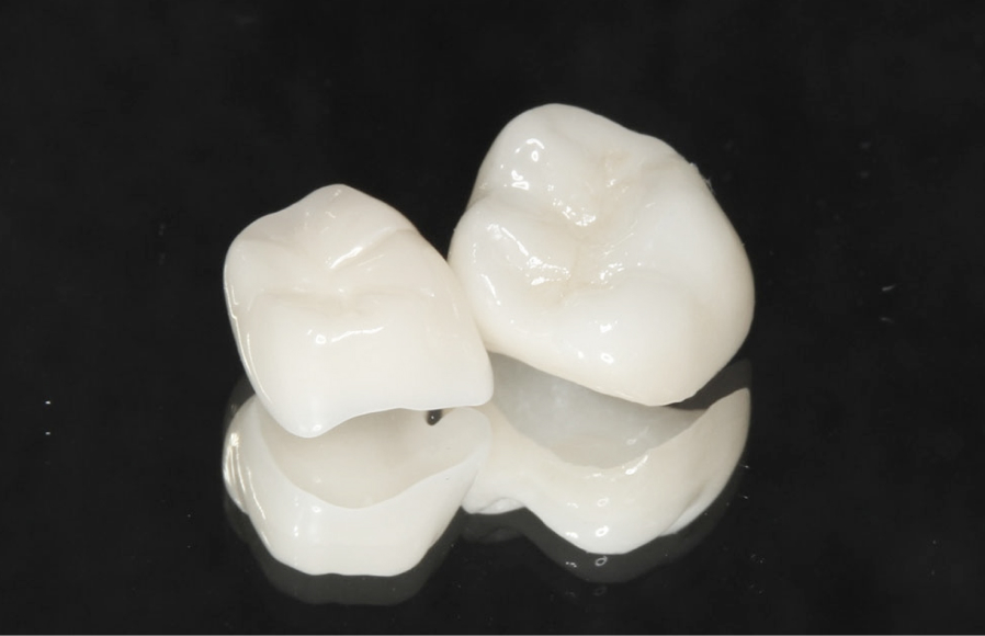 E-MAX（オールセラミックス）